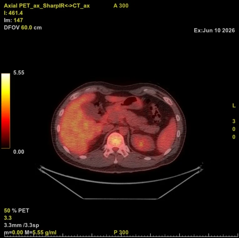 림프종 항암 후 PET-CT 복부 단면, Deauville score 1