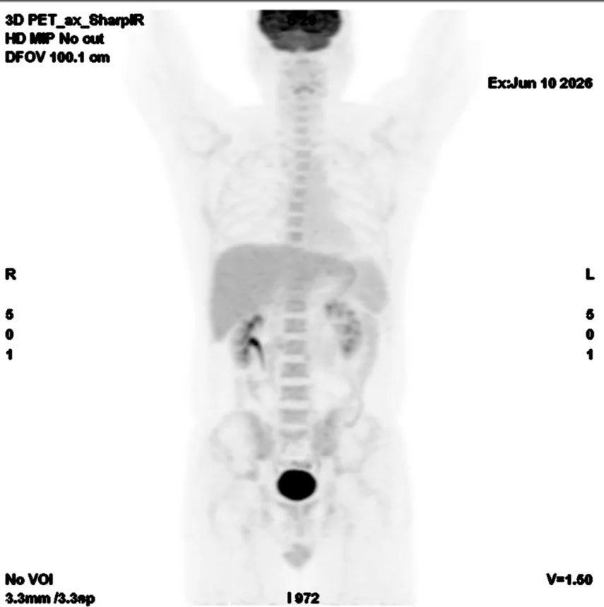 림프종 R-CHOP 6주기 후 PET-CT 전신 영상(2026년 6월)