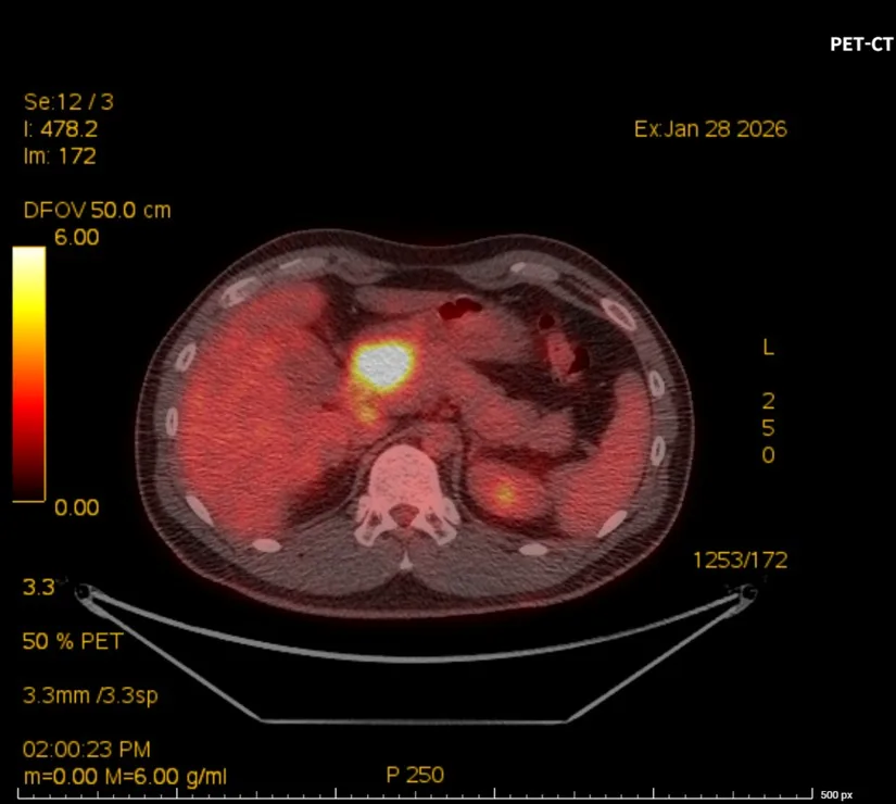 림프종 항암 전 PET-CT 복부 단면, 병변 FDG 섭취