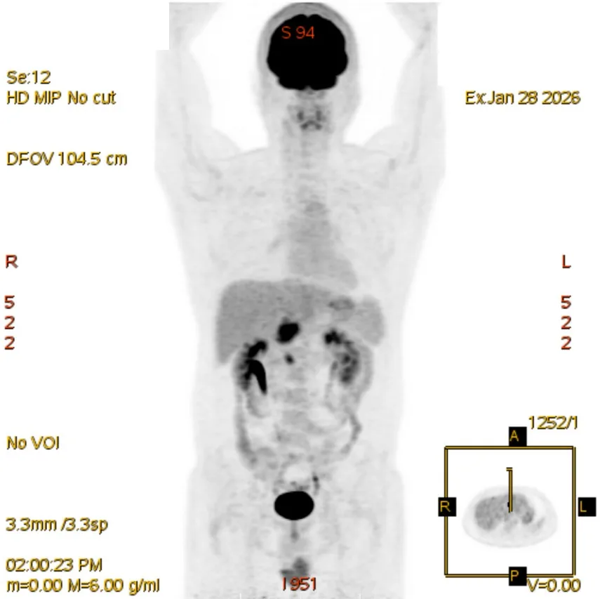 림프종 항암 전 PET-CT 전신 영상(2026년 1월)